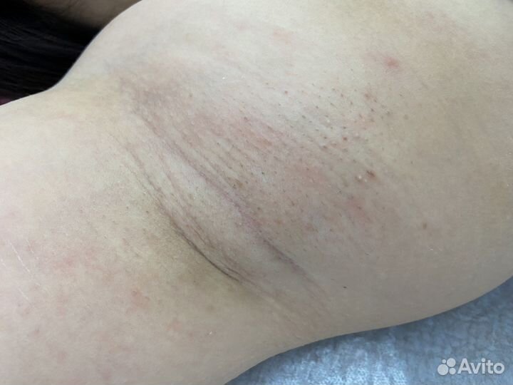 Депиляция шугаринг воск