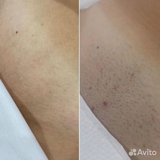 Лазерная эпиляция