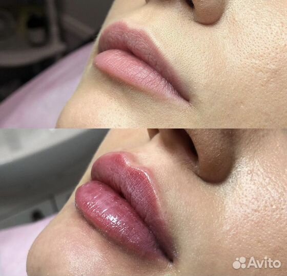 Модель на увеличение губ