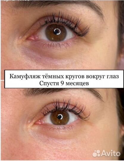 Камуфляж растяжек, удаление шрамов