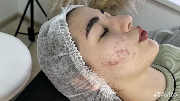 Косметолог чистка лица+пилинги