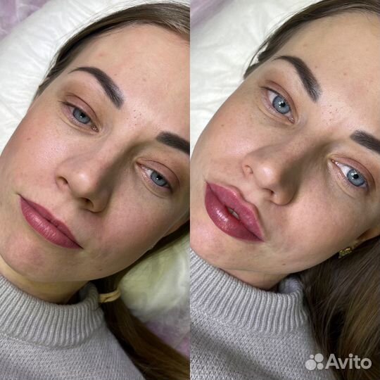 Увеличение губ