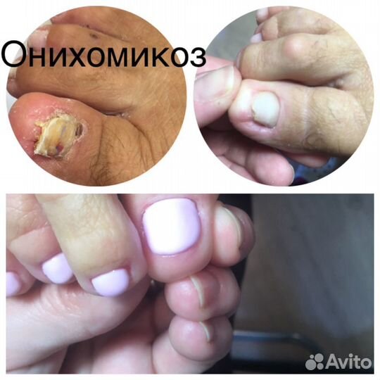 Медицинский педикюр,маникюр выезд на дом