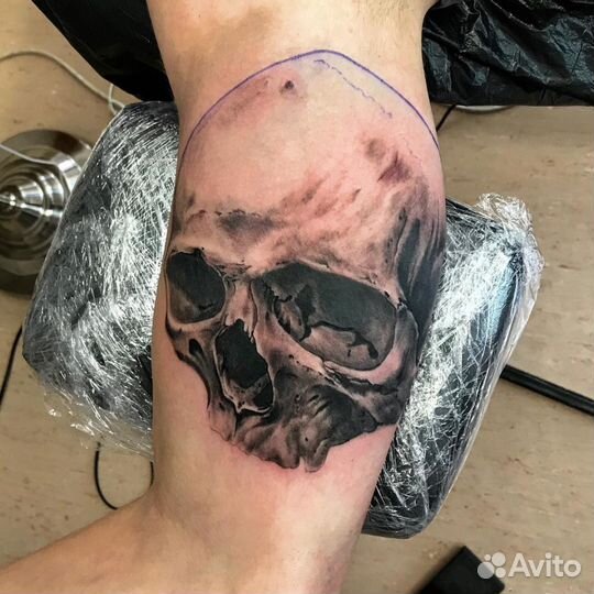 Удаление татуировок