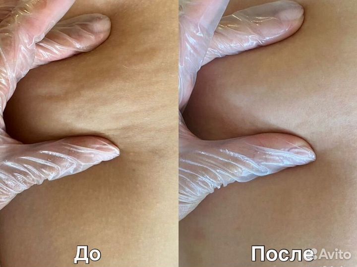 Антицеллюлитный массаж