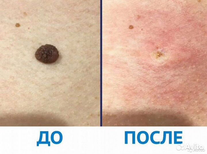 Лазер Папилломы Шрамы Растяжки