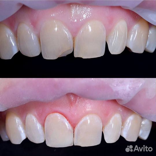 Пломба на зуб