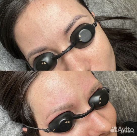 Удаление тату удаление тутажа лазером