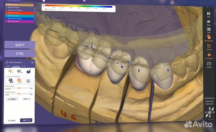 Hyperdent/3shape/ExoCad/3Diagnosys PlastyCad