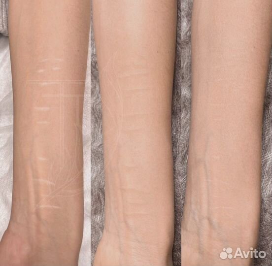 Перманентный макияж, камуфляж шрамов