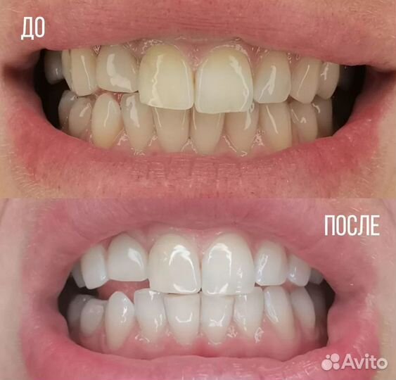 Подарочные сертификаты на отбеливания зубов