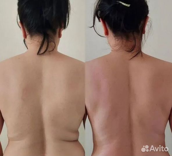 Ищу модель на криолиполиз