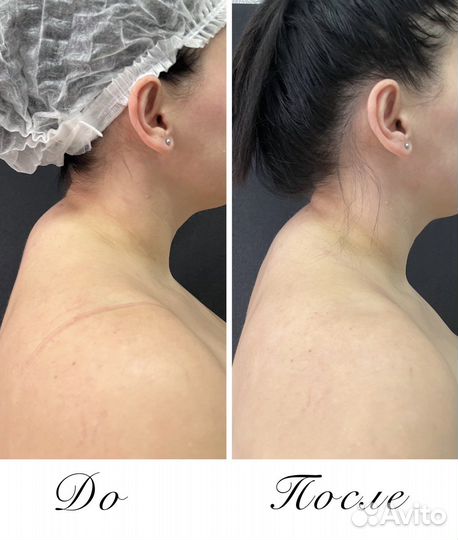 Массаж. Мадеротерапия.Ручная Липопластика