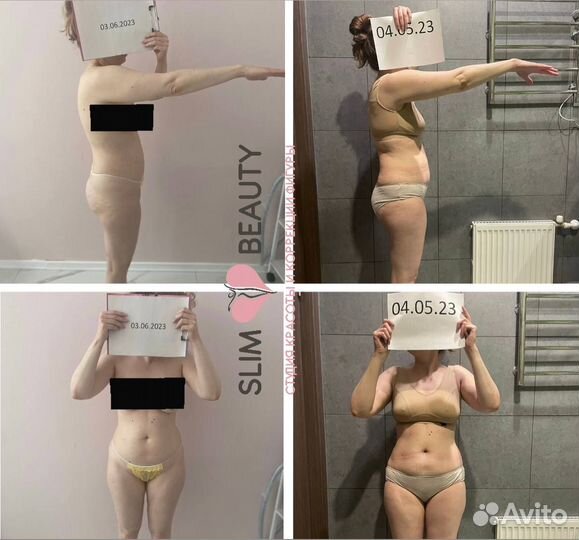 Аппаратная коррекция фигуры, криолиполиз,кавитация