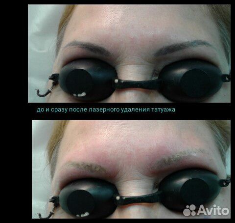 Лазерное удаление татуажа, тату