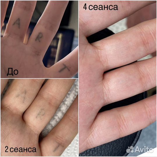 Удаление татуировок