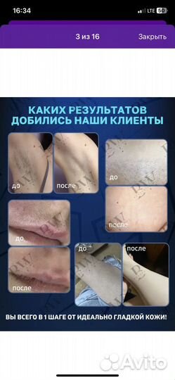 Фотоэпилятор