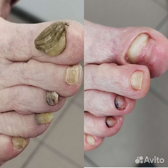 Услуги подолога с выездом на дом