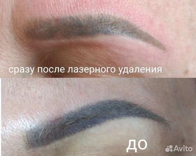 Удаление татуажа и татуировок. Лазер. Ремувер