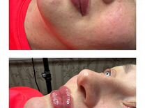 Увеличение губ врач Косметолог