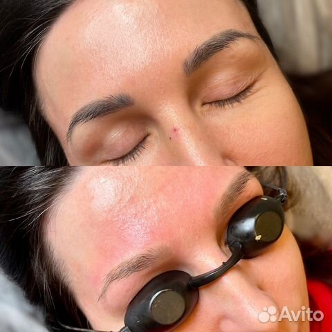 Лазерное удаление татуажа пикосекнудным лазером