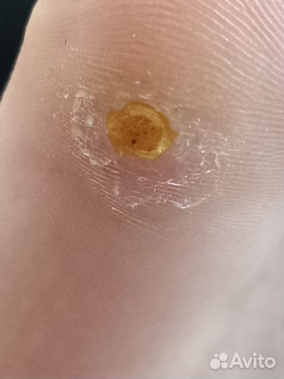 Вросший ноготь Подолог