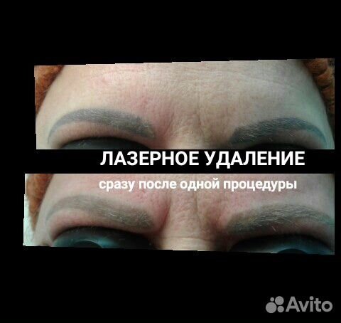 Лазерное удаление татуажа, тату