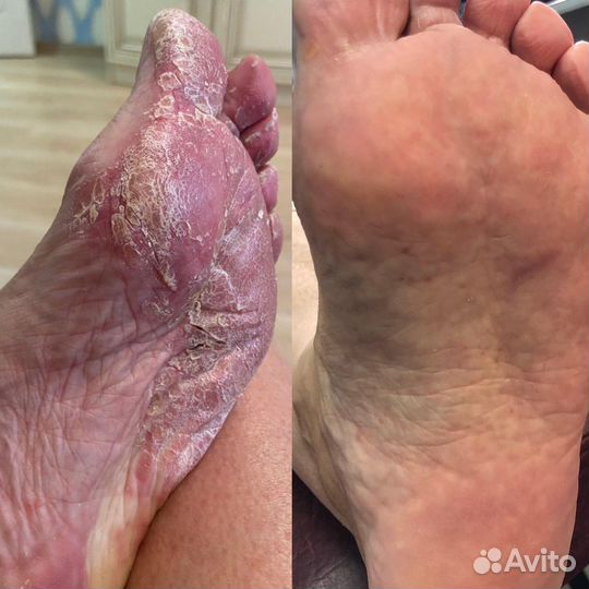 Педикюр лечебный, подология.наращивание ногтей