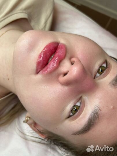 Увеличение губ