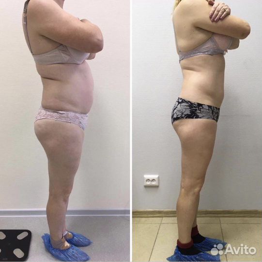 Вакуумно-роликовый массаж тела