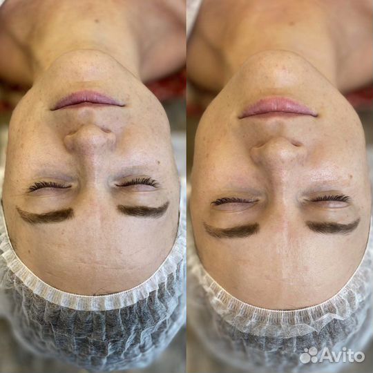 Карбокситерапия