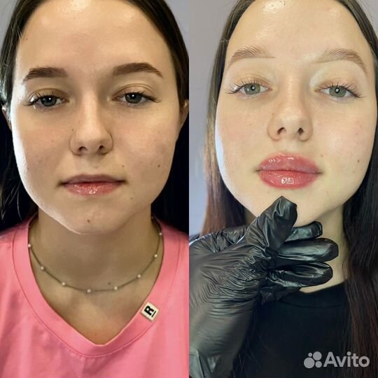 Модель на увеличение губ