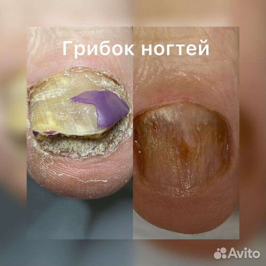 Медицинский педикюр. Подолог