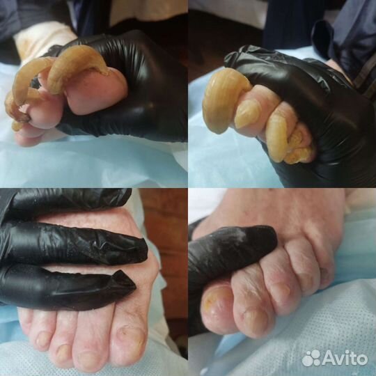 Аппаратный педикюр