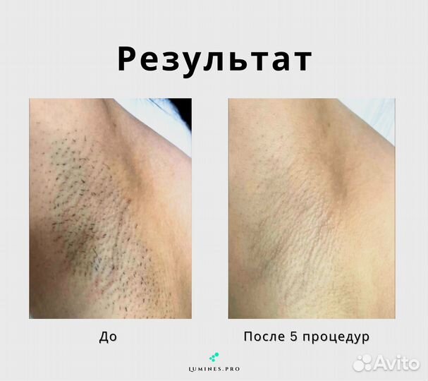 Диодный лазер для эпиляции Lumines’ Макс Ван 1200вт