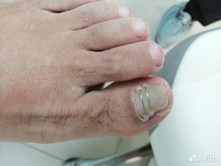 Педикюр подолог