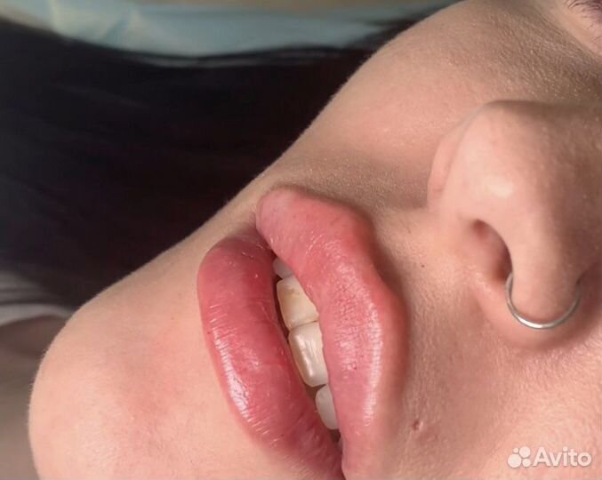 Модели на увеличение губ