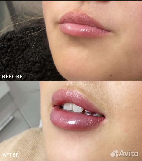 Косметолог увеличение губ