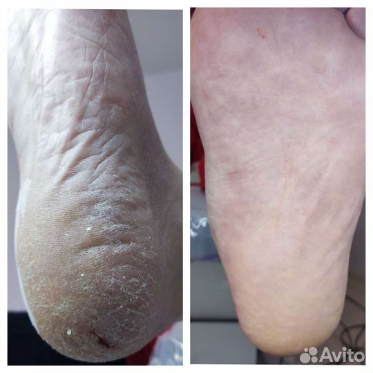 Медицинский педикюр/ подолог