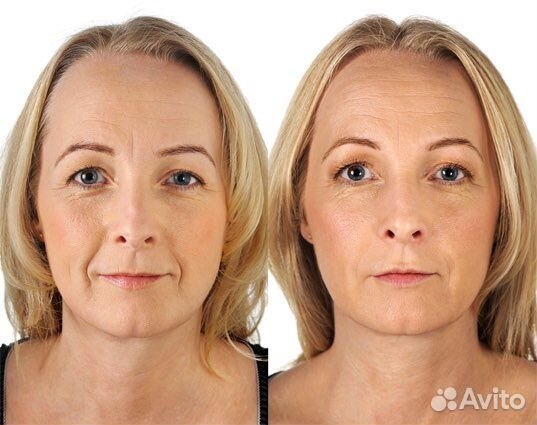 Дермотония