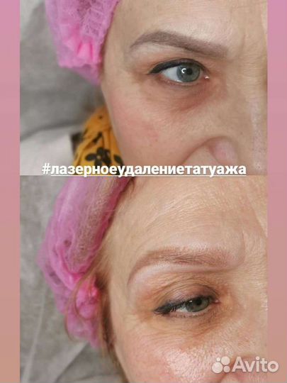 Лазерное удаление Тату, Татуажа, Карбоновый пилинг