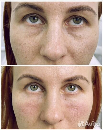 Биоревитализация