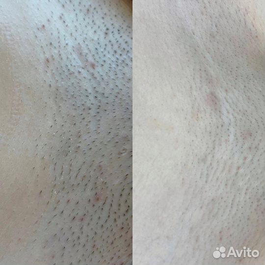 Лазерная эпиляция