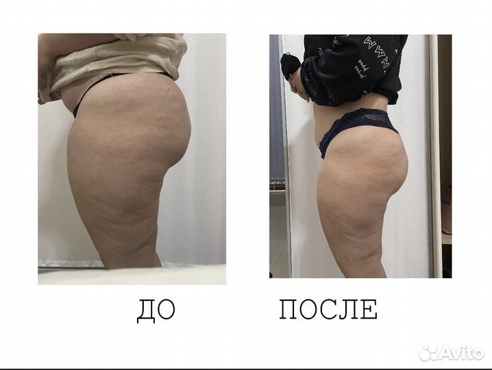 Криолиполиз/Массаж/Косметолог/Миостимуляция