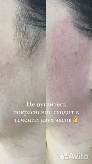 Шугаринг эпиляция