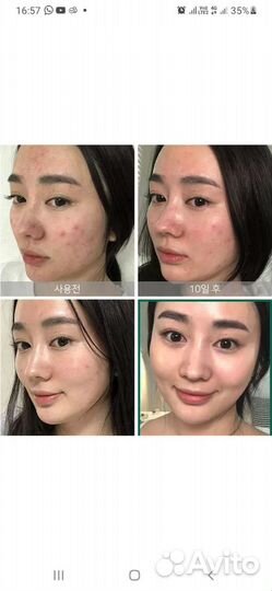 Лечение акне атоми