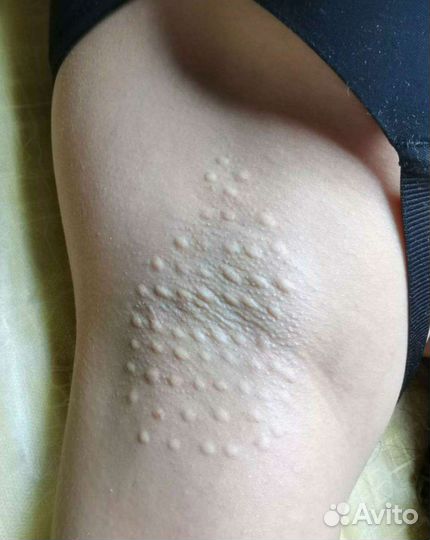 Контурная пластика