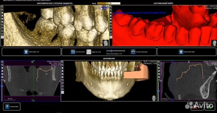 Hyperdent/3shape/ExoCad/Biblioteki Geo/PlastyCad