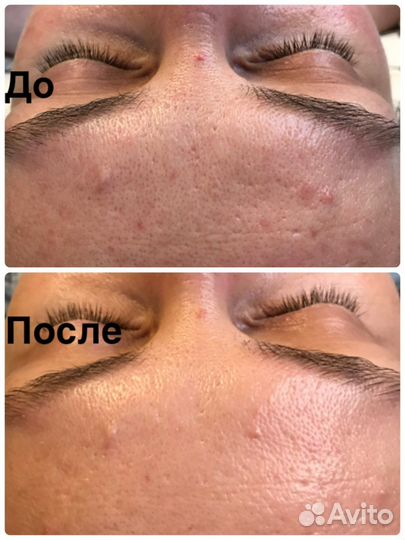 Комбинированная чистка лица