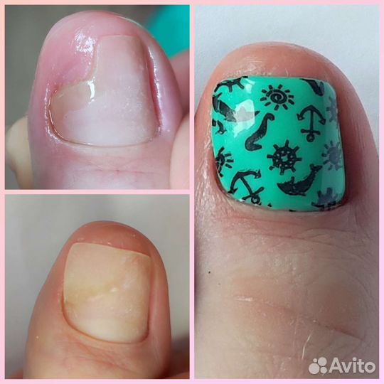 Подолог, педикюр, вросший ноготь, бородавка